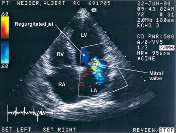 Echocardiogram A test in which ultrasound, a type of sound wave, is