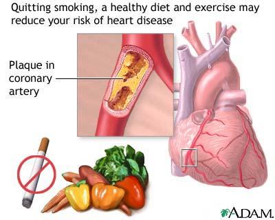 clot. Preventing eart Disease Prevention Do Not Smoke Check your blood pressure Decrease your intake of high