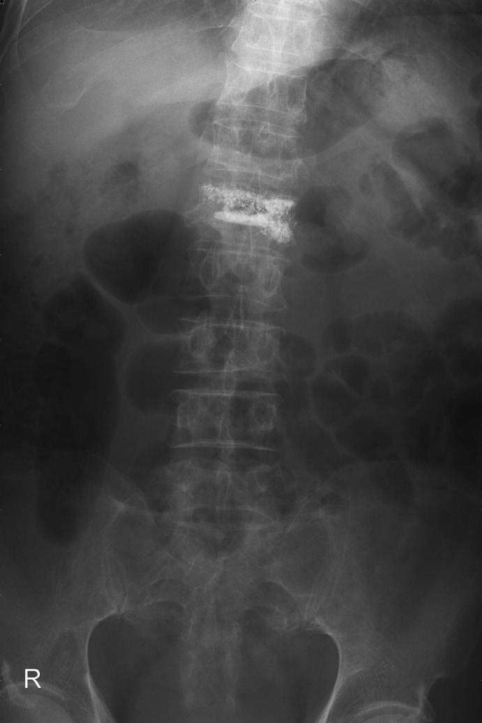 Sung Gon Kim, et al. ter of the vertebral body. If the injected cement did not cross the midline, the same procedure was repeated through the contralateral pedicle.