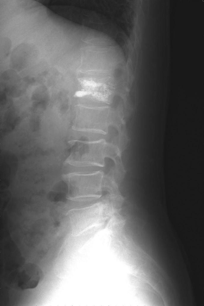 0 (range 61-92) Level of initial compression fracture Thoracolumbar (T12-L2) 084 Above T12 012 Below L2 016 Total 112 Comparison parameters Age, sex, bone mineral density (BMD), location of treated