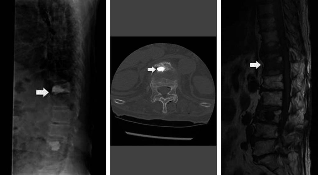 A 72-year-old female presented with back pain after vertebroplasty of T12 without a previous trauma history.