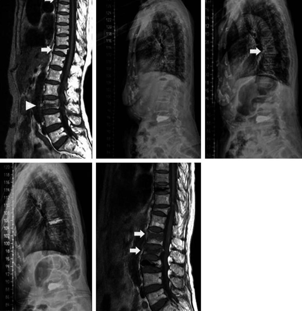 New Compression Fractures in Adjacent Vertebrae after Percutaneous Vertebroplasty / 185 late that an increase in vertebral level due to the injection of cement into a disc increases the weight borne