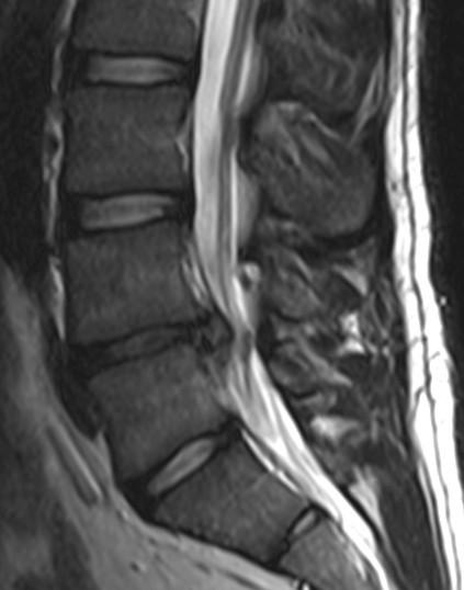 3. A 45 year old man was helping a friend move a piano when he experienced sudden lower back pain. Physical examination showed weakness in dorsiflexion of the foot.