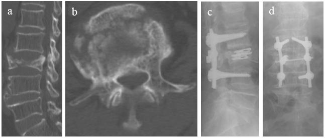 Minor essential revisions Could the authors add the photo of the I-VEP? Fig. 2 Patient 5 in Group I is a 79-year-old man who was treated with short-segment fixation with I-VEP due to VCF of L2.