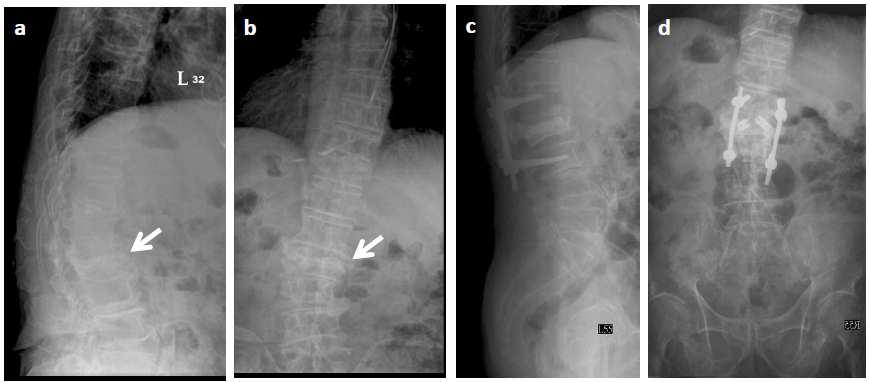 c Lateral-view radiographs at the one-year follow-up. d Anteroposterior view at the one-year follow-up. [P. 19] Fig.