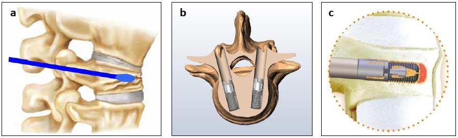 Fig. 7 Illustration of I-VEP placement. a Detection of the pedicle tract, insertion of the probe to the collapse area and entrance into the center of the vertebra in the sagittal plane.