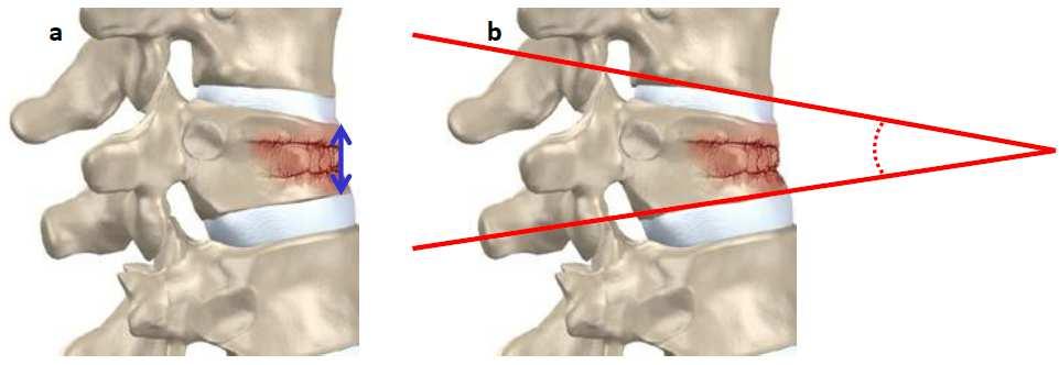 2 Local kyphosis index should include the disc spaces. Fig. 5 Schematic diagrams of the radiographic measurements.