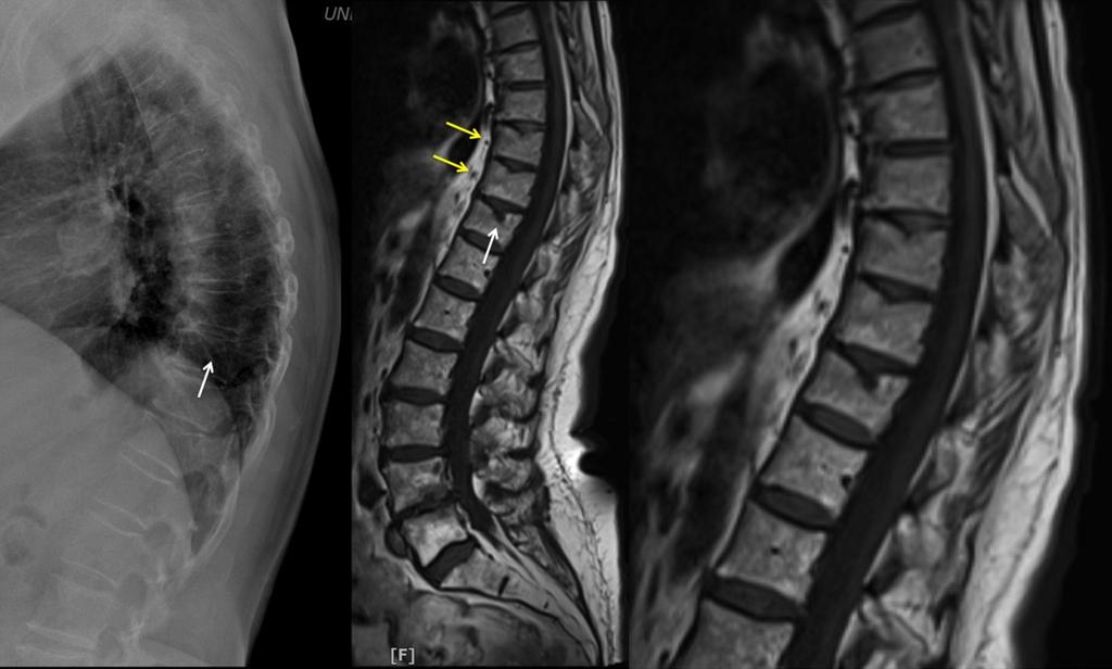 Fig. 6: In this patient XR diagnoses a Schmorl's node at T12 level confirmed by MRI.