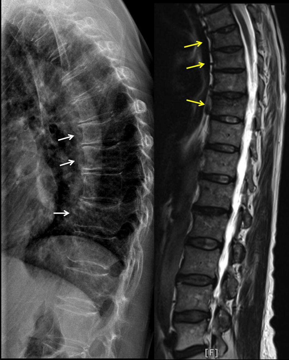 Fig. 3: Both XR and MRI show moderate