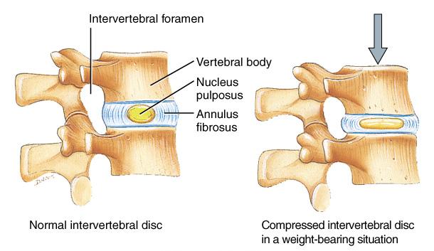 Intervertebral Discs Positioned between adjacent vertebrae Absorb vertical shock