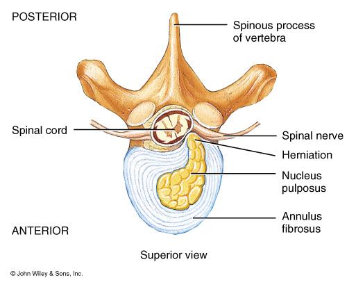 Herniated (Slipped) Disc Protrusion of the nucleus pulposus Most commonly in lumbar