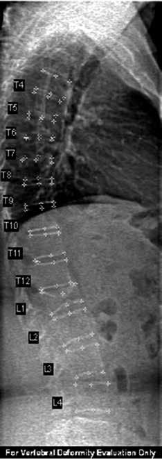 lowed by the appropriate treatment, aids in preventing new fractures (14). Therefore it is important to identify vertebral fractures as early as possible.