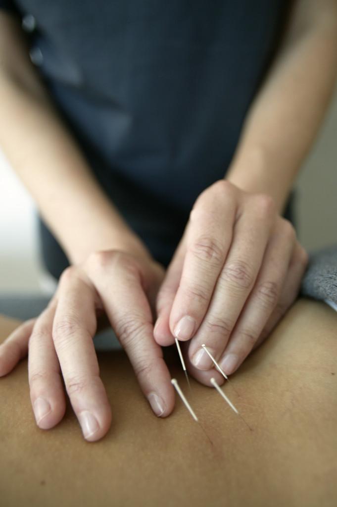 Acupuncture The insertion of tiny, filiform needles at specific points on the body to
