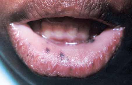 Table Causes of pigmented oral lesions Physiologic pigmentation (racial, oral melanotic macule) Genetic causes (Peutz-Jeghers syndrome, Recklinghausen s disease, Albright s syndrome, Carney syndrome)