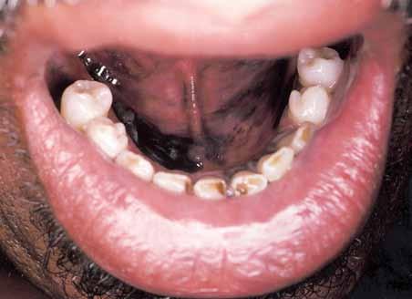 CLINICAL HIGHLIGHTS q The classic endocrine syndrome characterized by oral melanosis is Addison s disease.