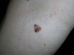 Melanoma types Superficial spreading melanoma most