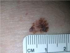 15-30% Lentigo maligna melanoma 4-15% Acral