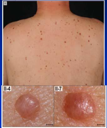 individual with uveal melanoma One family had three members with cutaneous melanoma Affected individuals with multiple (5-50) skin colored, red to brown dome shaped papules Beginning in the second