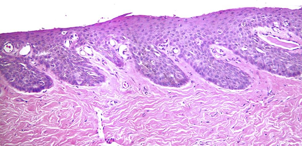 Figure 4. Low power micrograph of an H&E stained specimen of nail matrix from Case 1. It is difficult to distinguish melanocytes from keratinocytes. [Copyright: 2012 Rosendahl et al.] Figure 6.