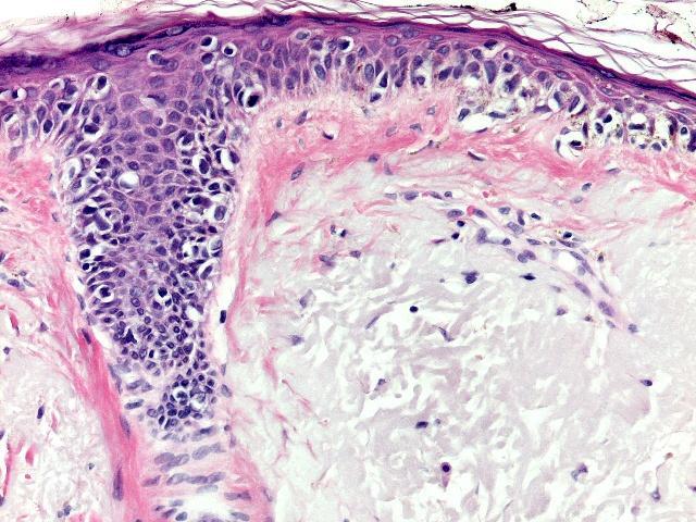Neoplastic melanocytes spread from the junction upwards and along the adnexa.