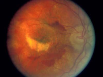 Choroidal Neovascularization 10% of patients, 90% of severe vision loss Disciform