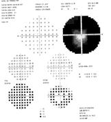 Visual fields: 2007 Visual fields: 2009 Fundus Photos: 2009 Retinal Toxicity and Hydroxychloroquine Rare
