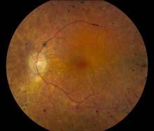 loss of peripheral visual field, night vision, widespread fundus changes Toxicity can be prevented if the drug