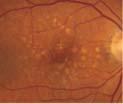 Retinal Toxicity and Hydroxychloroquine Risk factors: Daily dose greater than 6.