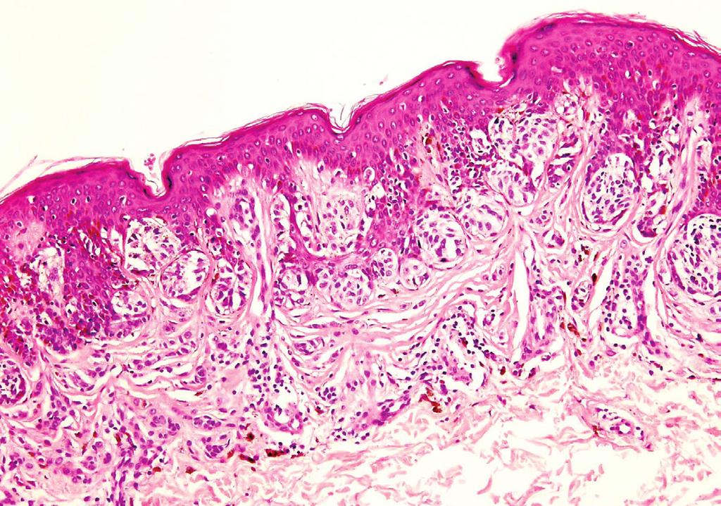 FEATURE ARTICLE histological margins are clear of the melanoma in situ component and a clinical excision margin of 5mm has been achieved, it is unnecessary (and often impossible) to achieve