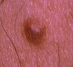 Subtype: Giant hairy nevus Intradermal