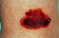 Types of Melanoma Superficial spreading melanoma (anywhere / Irregular / raised / epidermal)