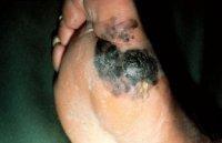 Lentigo maligna melanoma (LMM) (Hutchinson Melanotic Freckle) (Face / elderly / basal layer of