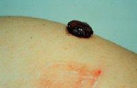 commonly on the face. Acral-lentiginous melanoma most frequent in blacks and Asians.