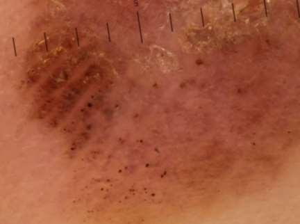 (sweat gland openings) Acral melanoma - thick brown
