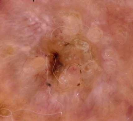 in thin actinic keratoses (sometimes referred to as strawberry-like) o o White circles on a yellow-brown background can be seen in solar lentigo