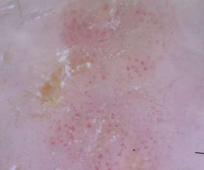 white) and structureless Benign melanocytic naevi and congenital melanocytic naevi - can have skin-coloured structureless areas Melanoma An eccentric pink, brown, black, blue-white (sometimes