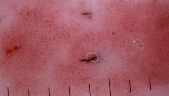 large red dots. Seen in Bowen s disease and stasis dermatitis.