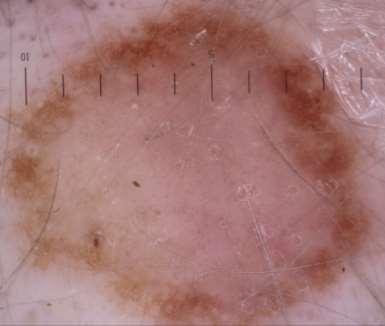Benign melanocytic naevus in a fair-skinned