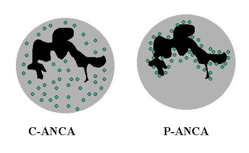 Specific Targets of ANCAs We now know specific antigens that stain in these patterns and how they correlate with specific diseases C-ANCA is Proteinase 3 and correlates with WG P-ANCA is usually