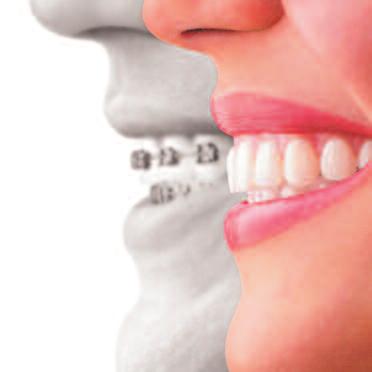 teeth Teeth straightening leads