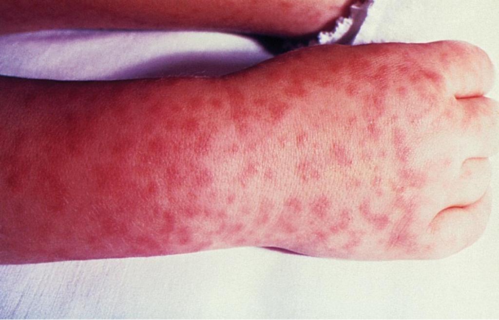 Rocky Mountain Spotted Fever First symptoms are fever, chills, headache and a spotted rash appears in days