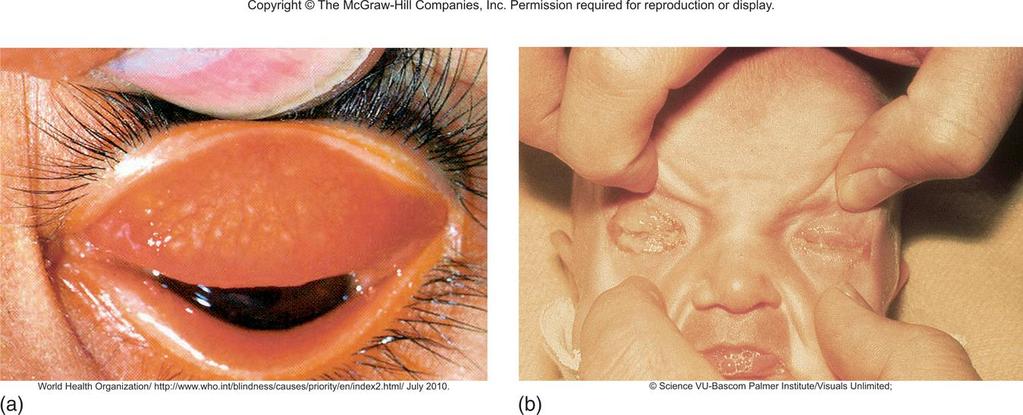 Diseases of Chlamydia trachomatis Human reservoir and 2 strains can infect humans: Trachoma attacks the mucous membranes of the eyes, genitourinary tract, and lungs Ocular trachoma: severe infection,