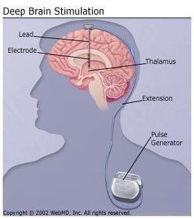Figure 3: Image depicting Deep Brain Stimulation process. Source: Deep Brain Stimulation. WebMD. Accessed April 15, 2017.