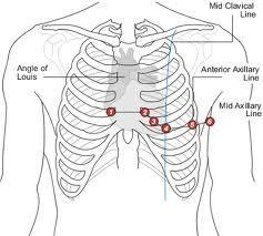 3.4: The chest leads are positioned as follows: Lead C1 C2 C3 C4 C5 C6 Position of Chest Leads 4 th Intercostal space, right sternal edge 4 th Intercostal space, left sternal edge Midway between C2