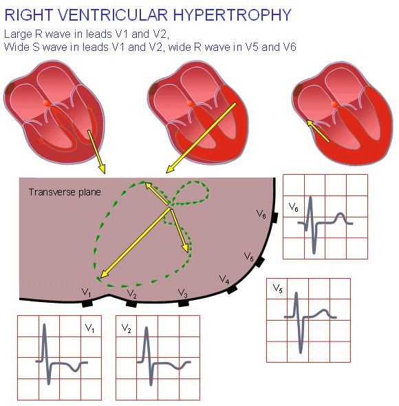 Right Ventricular Hypertrophy