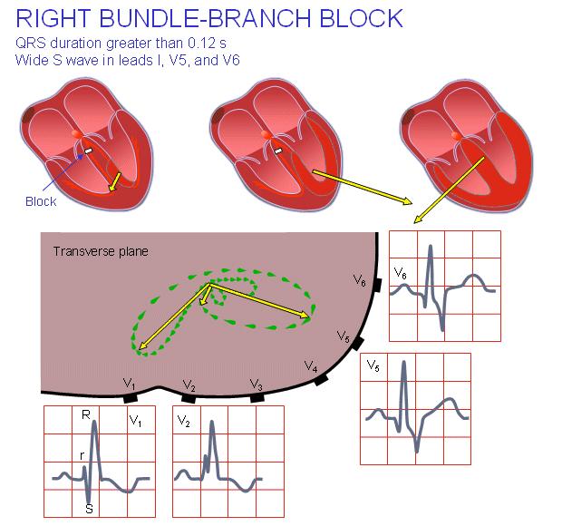 Right Bundle Branch Block (RBBB)