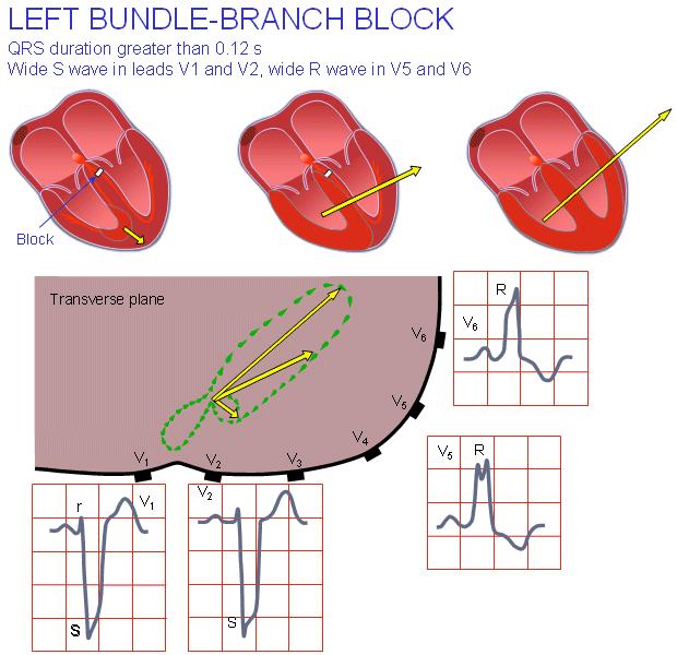 Left Bundle Branch Block (LBBB)