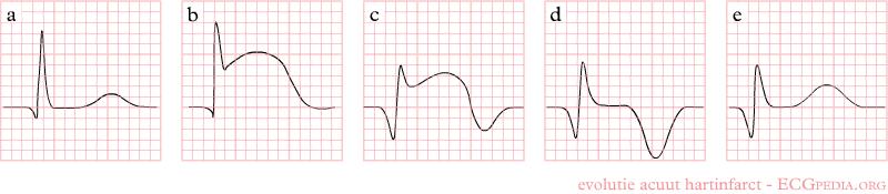 Evolution of an Acute MI The evolution of an infarct on the ECG.