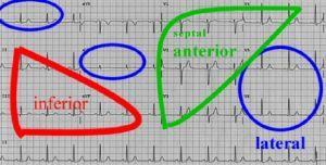 org/2010/05/quick-guide-to-ecg.