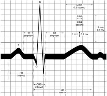 ECG Recording Slide 40 Identify an AMI Know what to look for: Measure from J point ST elevation or